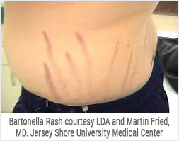 Bartonella Rash