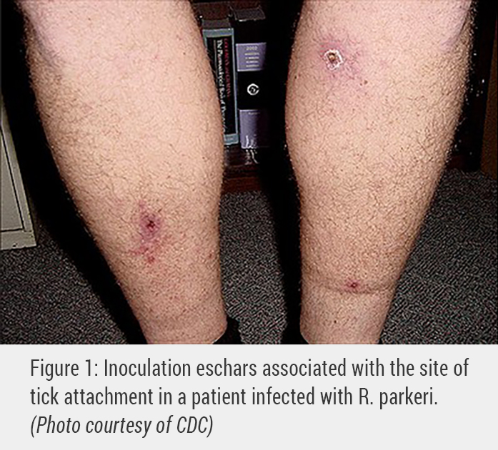 Patients may also have an eschar type of rash