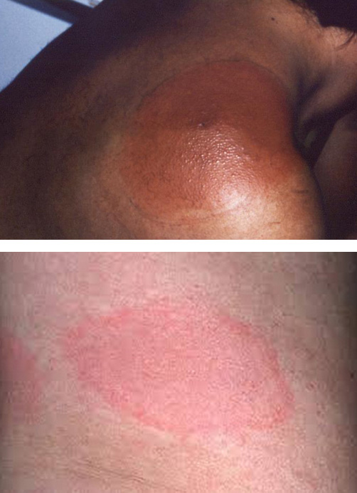 lyme disease rash