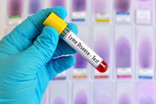 Lyme Disease Tests