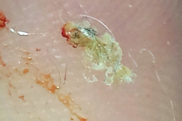 Morgellons lesion