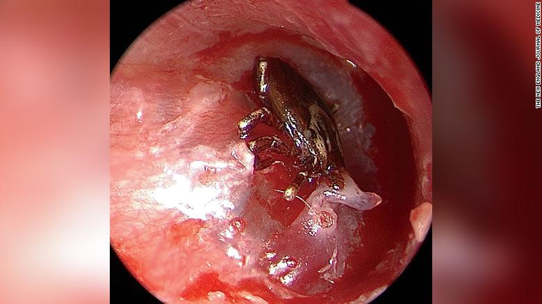 tick in eardrum