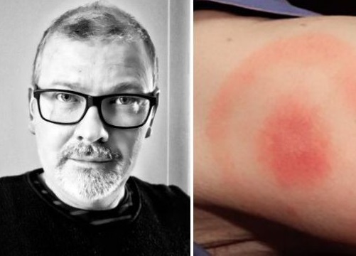 Lyme disease mistaken for stroke