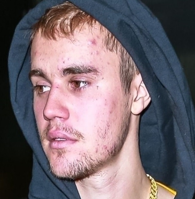 justin bieber has Lyme disease