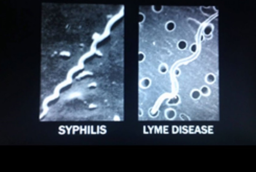 morgellons staging